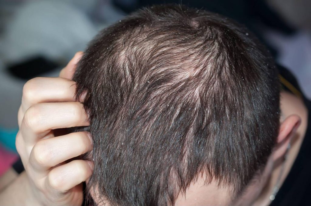 male alopecia