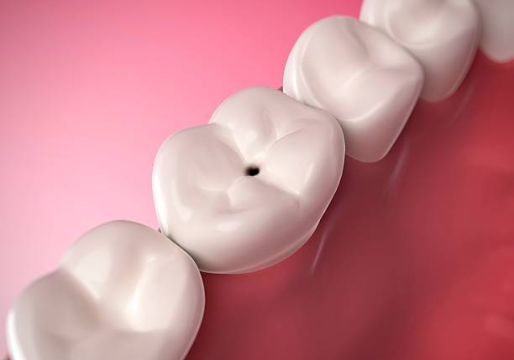 How To Reverse a Cavity at Home Cure Tooth Decay