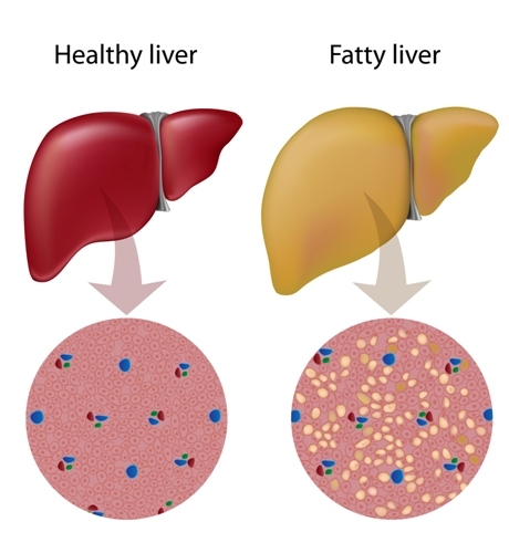 How to Fix FATTY LIVER In Weeks